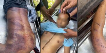 Motorbike mechanic Ko Min Min sustained bruises on his back and scratches on his arms. / Supplied