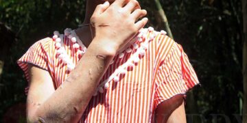 Scars are visible on the arm and hand of Ma San Kay Khaing, who escaped from five years in domestic servitude in Rangoon’s Kyauktada Township. / Lawi Weng / The Irrawaddy