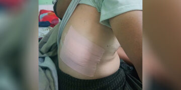 School headmaster Lahpai Zau Shan Lum is treated for shrapnel wounds at the hospital in Kutkai Town in Shan State. / Helen Mai / Facebook