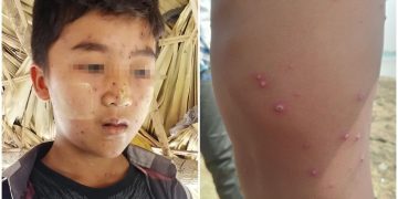 Myanmar Junta Preventing Medicine Reaching Sick Children in Sagaing